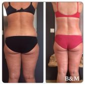 bioslimming-ulft