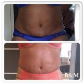 bioslimming-wrap