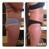 bioslimming